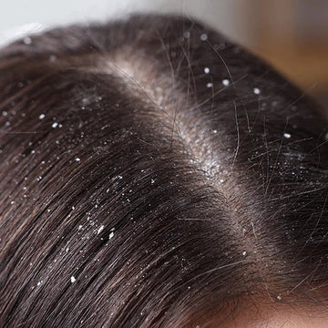 Dandruff