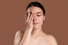 Acne / Pimple