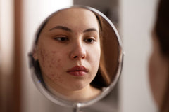 Post Acne Marks