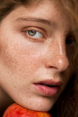 Hyperpigmentation